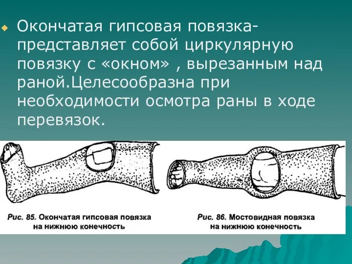 Окончатая гипсовая повязка-представляет собой циркулярную повязку с «окном» , вырезанным