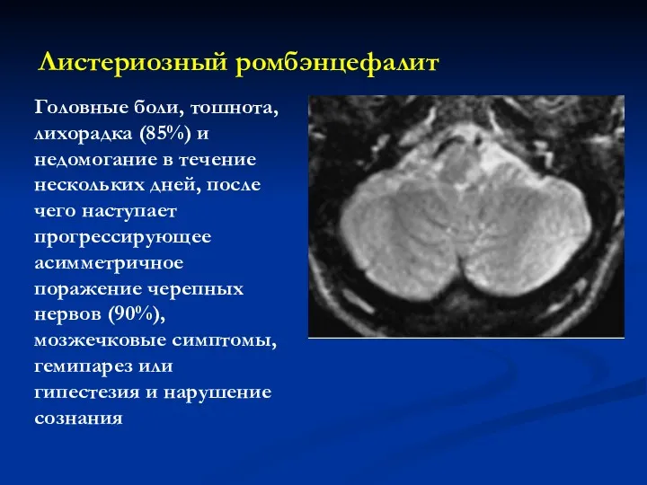 Листериозный ромбэнцефалит Головные боли, тошнота, лихорадка (85%) и недомогание в