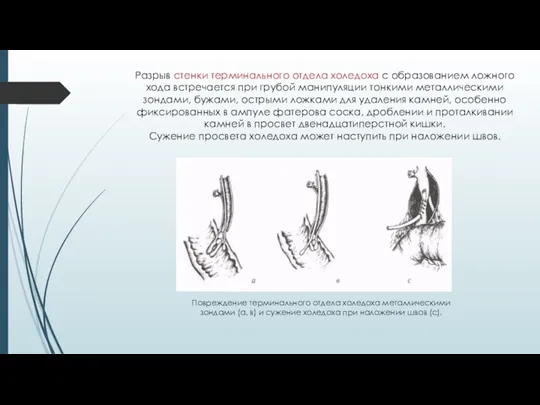 Разрыв стенки терминального отдела холедоха с образованием ложного хода встречается