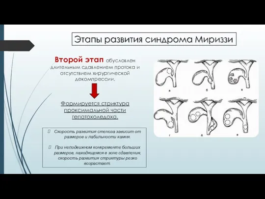 Второй этап обусловлен длительным сдавлением протока и отсутствием хирургической декомпрессии.