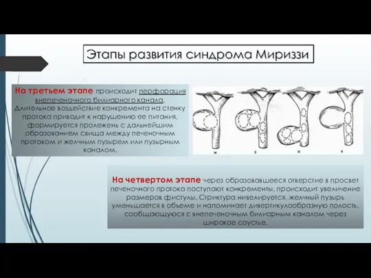 На четвертом этапе через образовавшееся отверстие в просвет печеночного протока