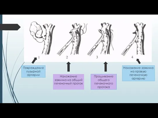 Наложение зажима на правую печеночную артерию Повреждение пузырной артерии Наложение