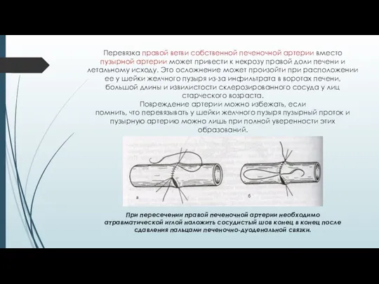 Перевязка правой ветви собственной печеночной артерии вместо пузырной артерии может