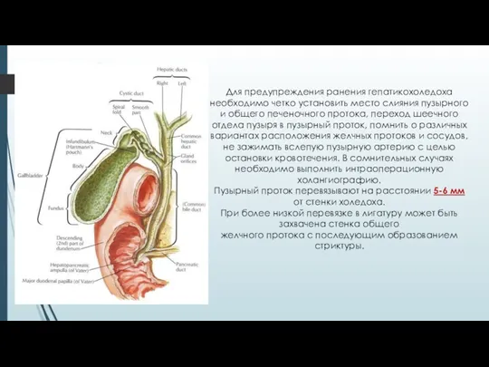 Для предупреждения ранения гепатикохоледоха необходимо четко установить место слияния пузырного