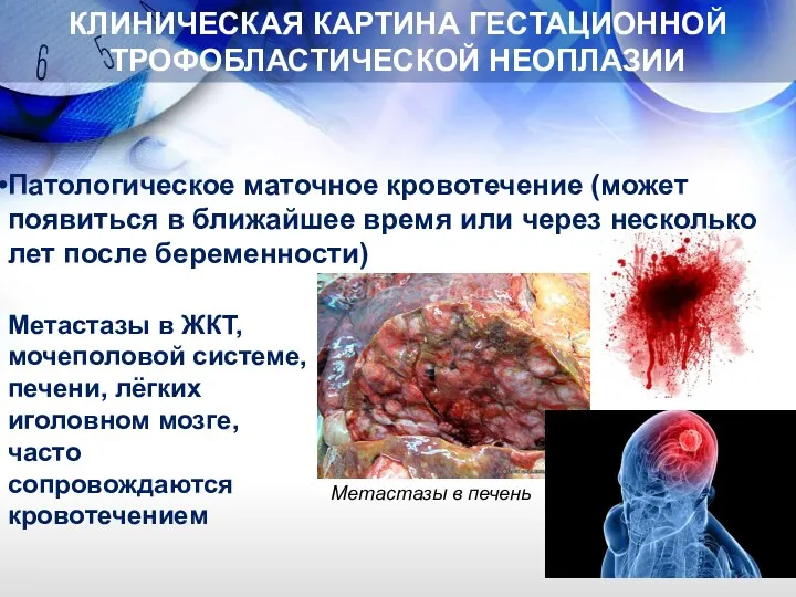 КЛИНИЧЕСКАЯ КАРТИНА ГЕСТАЦИОННОЙ ТРОФОБЛАСТИЧЕСКОЙ НЕОПЛАЗИИ Патологическое маточное кровотечение (может появиться