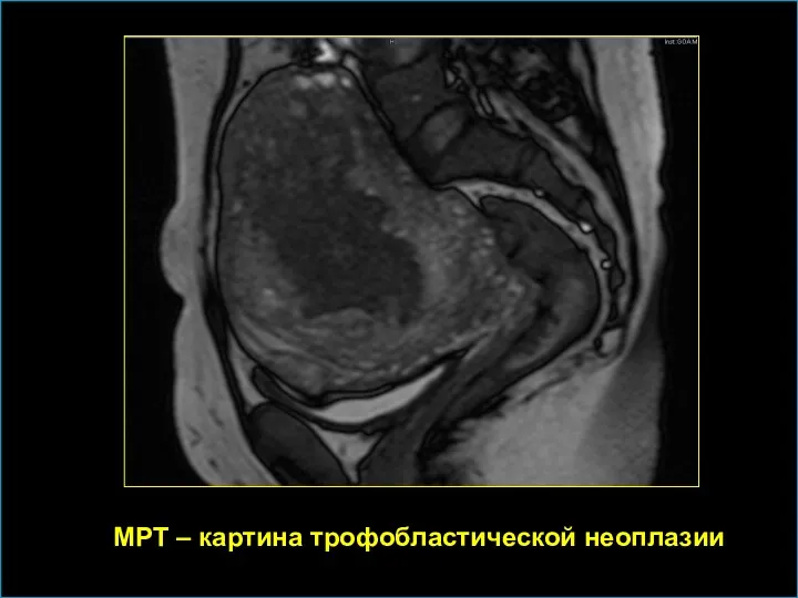 МРТ – картина трофобластической неоплазии
