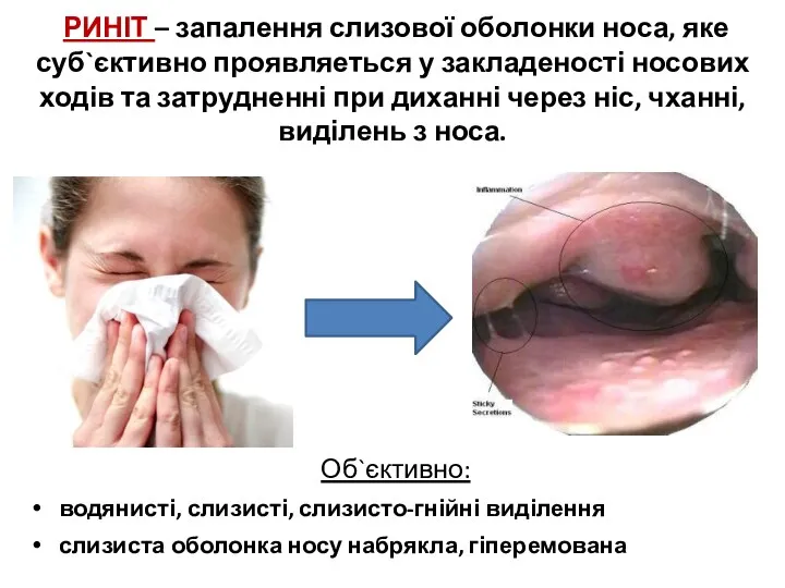 РИНІТ – запалення слизової оболонки носа, яке суб`єктивно проявляеться у закладеності носових ходів