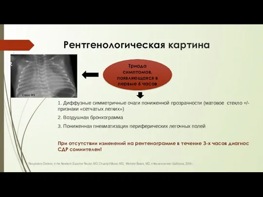 Рентгенологическая картина 1. Диффузные симметричные очаги пониженной прозрачности (матовое стекло