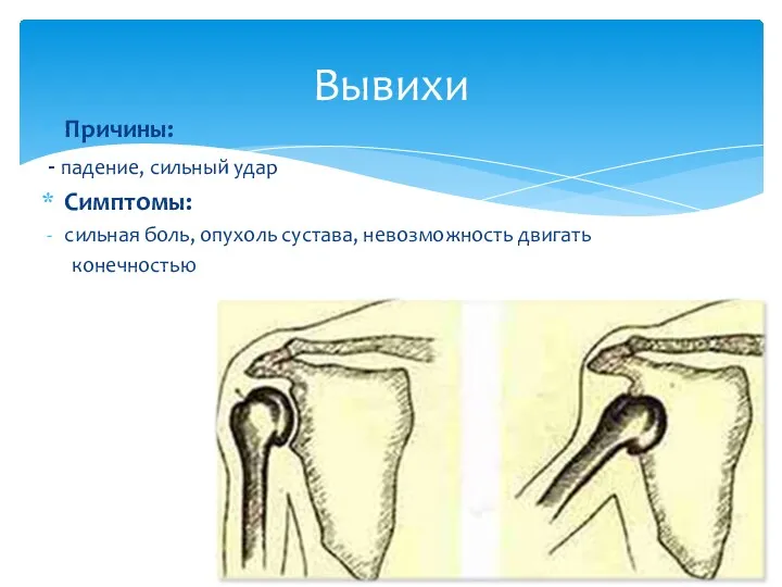 Причины: - падение, сильный удар Симптомы: сильная боль, опухоль сустава, невозможность двигать конечностью Вывихи