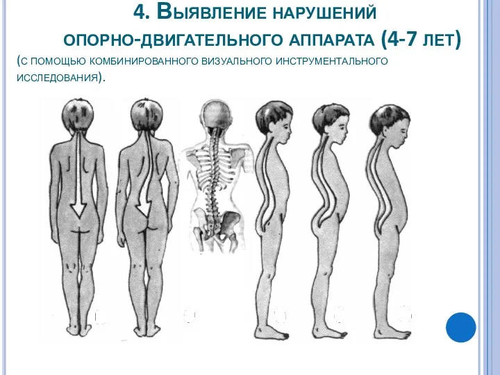 4. Выявление нарушений опорно-двигательного аппарата (4-7 лет) (с помощью комбинированного визуального инструментального исследования).