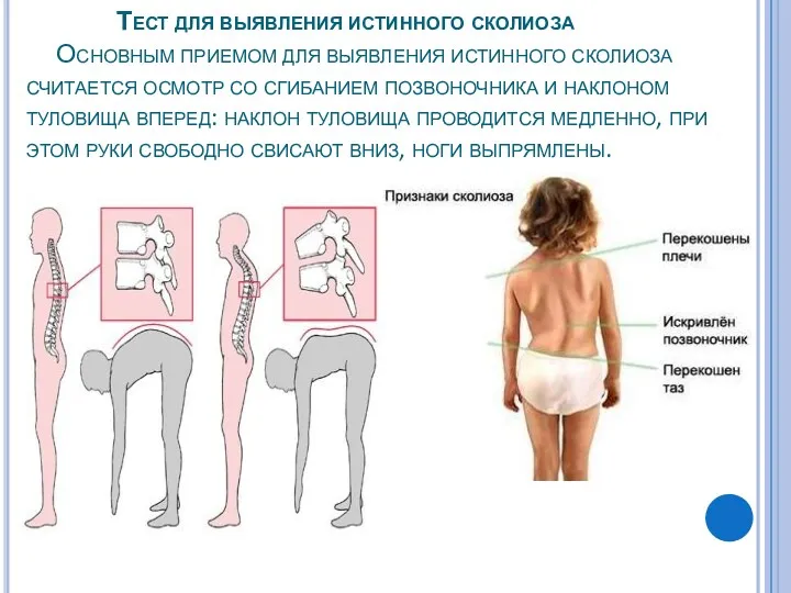 Тест для выявления истинного сколиоза Основным приемом для выявления истинного