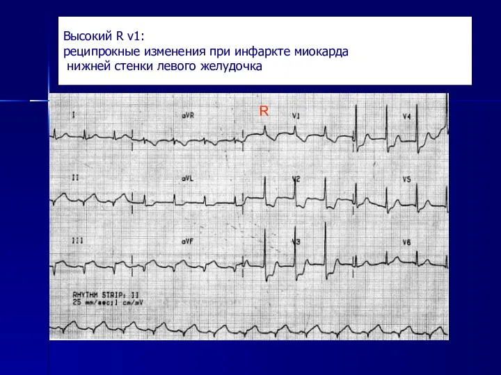 Высокий R v1: реципрокные изменения при инфаркте миокарда нижней стенки левого желудочка R