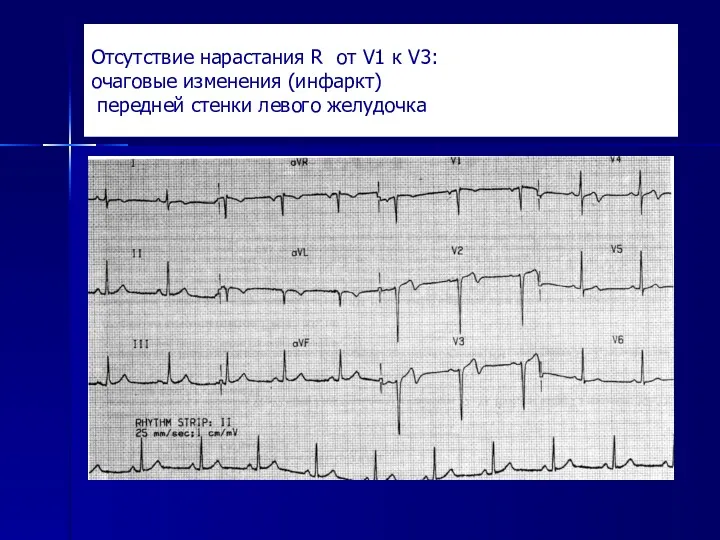 Отсутствие нарастания R от V1 к V3: очаговые изменения (инфаркт) передней стенки левого желудочка