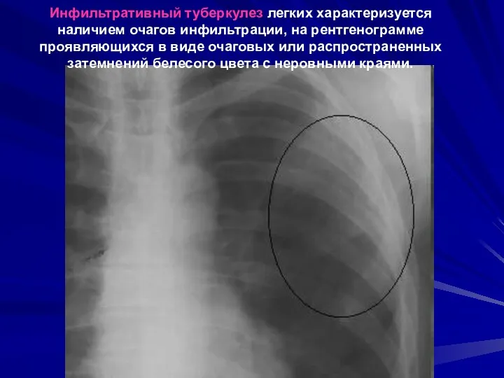 Инфильтративный туберкулез легких характеризуется наличием очагов инфильтрации, на рентгенограмме проявляющихся