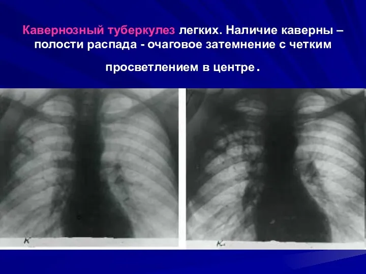 Кавернозный туберкулез легких. Наличие каверны – полости распада - очаговое затемнение с четким просветлением в центре.