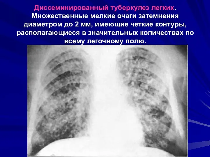 Диссеминированный туберкулез легких. Множественные мелкие очаги затемнения диаметром до 2