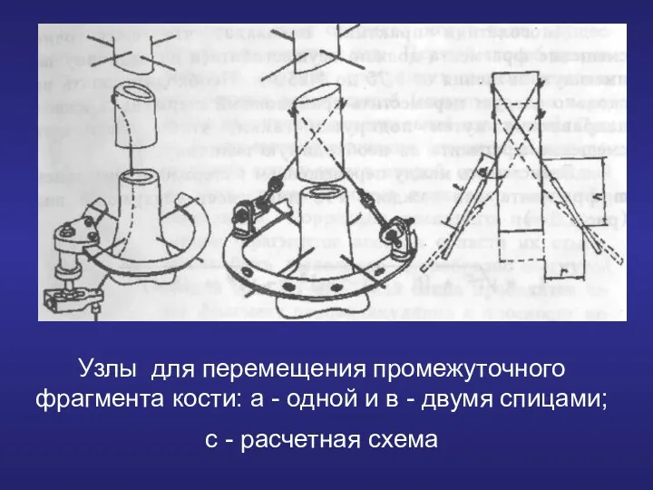 Узлы для перемещения промежуточного фрагмента кости: а - одной и