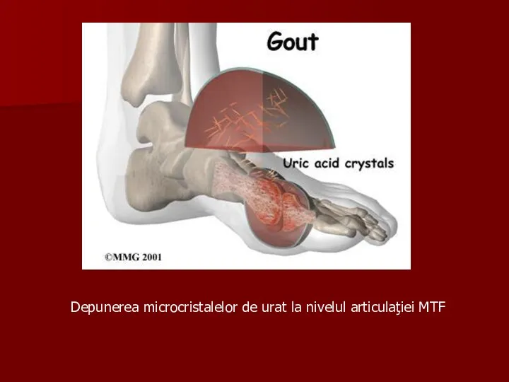 Depunerea microcristalelor de urat la nivelul articulaţiei MTF