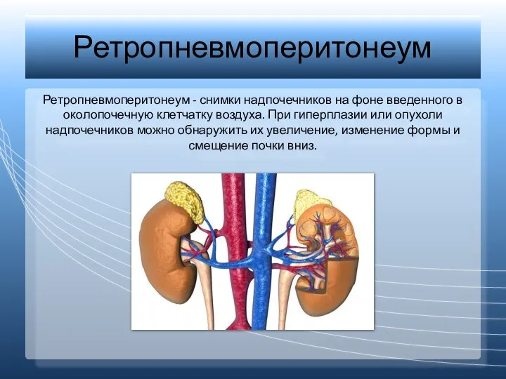 Ретропневмоперитонеум Ретропневмоперитонеум - снимки надпочечников на фоне введенного в околопочечную