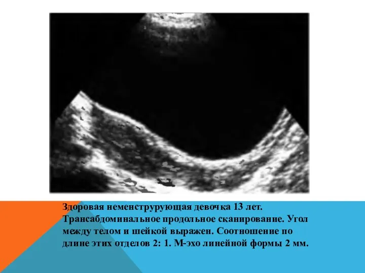 Здоровая неменструрующая девочка 13 лет. Трансабдоминальное продольное сканирование. Угол между телом и шейкой