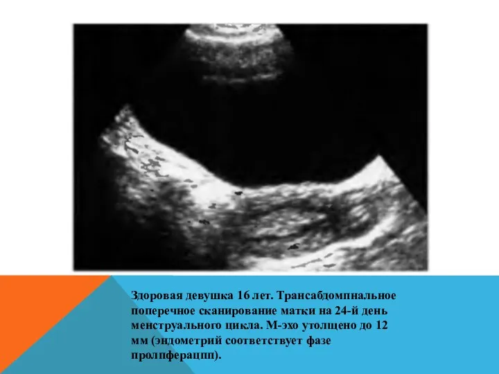 Здоровая девушка 16 лет. Трансабдомпнальное поперечное сканирование матки на 24-й день менструального цикла.