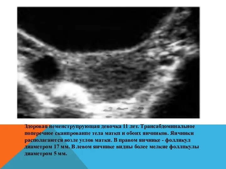 Здоровая неменструпрующая девочка 11 лет. Трансабдоминальное поперечное сканпрованпе тела маткп и обоих яичников.
