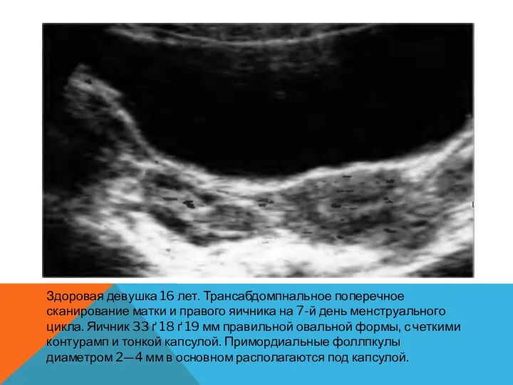 Здоровая девушка 16 лет. Трансабдомпнальное поперечное сканирование матки и правого яичника на 7-й