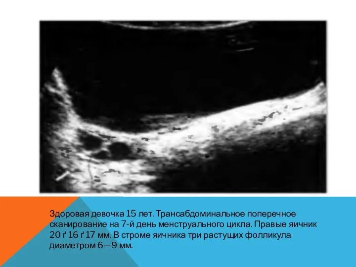 Здоровая девочка 15 лет. Трансабдоминальное поперечное сканирование на 7-й день менструального цикла. Правые