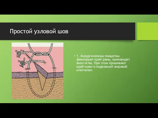 Простой узловой шов 1. Хирургическим пинцетом фиксируют край раны, производят вкол иглы. При