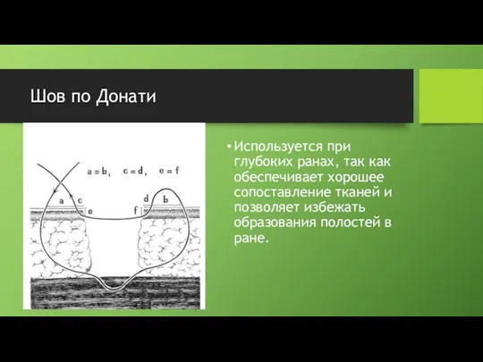 Шов по Донати Используется при глубоких ранах, так как обеспечивает хорошее сопоставление тканей