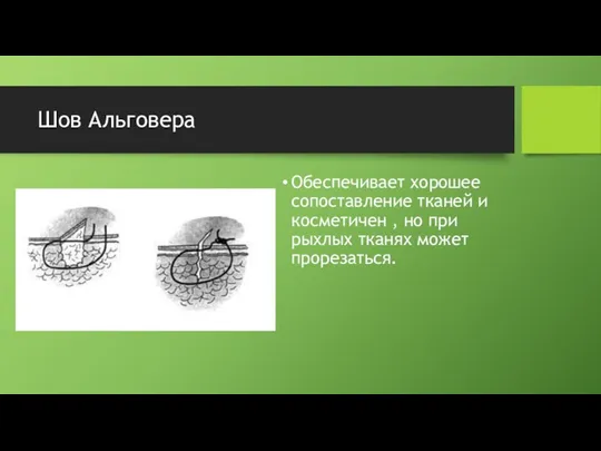 Шов Альговера Обеспечивает хорошее сопоставление тканей и косметичен , но при рыхлых тканях может прорезаться.