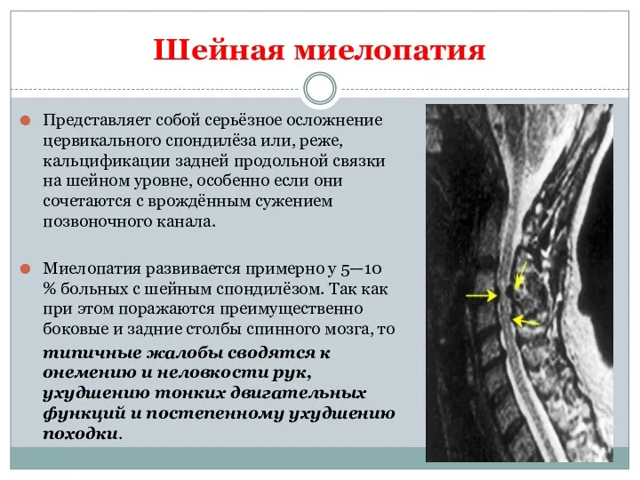 Шейная миелопатия Представляет собой серьёзное осложнение цервикального спондилёза или, реже,