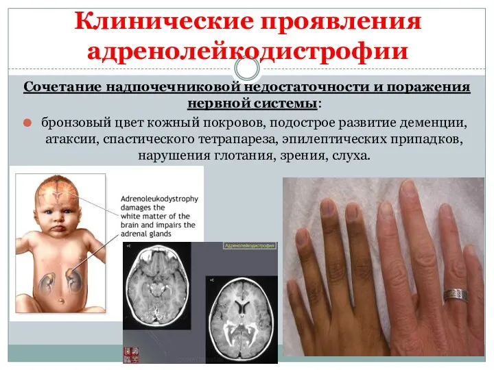 Клинические проявления адренолейкодистрофии Сочетание надпочечниковой недостаточности и поражения нервной системы: