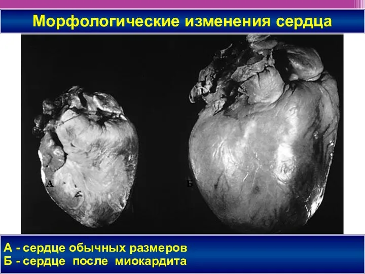 А - сердце обычных размеров Б - сердце после миокардита А Б Морфологические изменения сердца