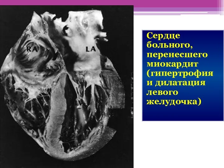 Сердце больного, перенесшего миокардит (гипертрофия и дилатация левого желудочка)