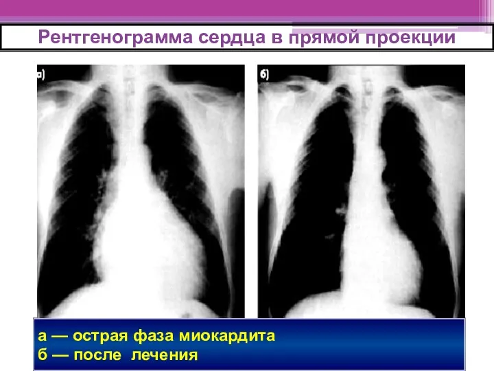 а — острая фаза миокардита б — после лечения Рентгенограмма сердца в прямой проекции