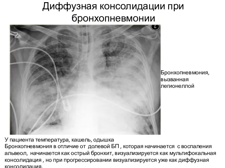 Диффузная консолидации при бронхопневмонии У пациента температура, кашель, одышка Бронхопневмония