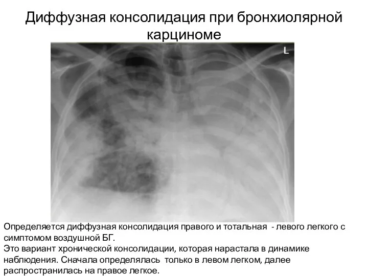 Диффузная консолидация при бронхиолярной карциноме Определяется диффузная консолидация правого и