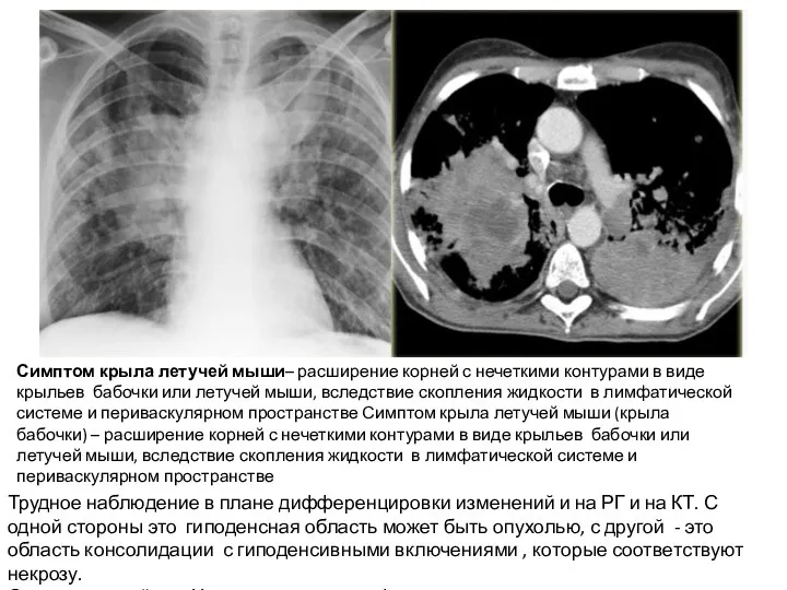 Трудное наблюдение в плане дифференцировки изменений и на РГ и