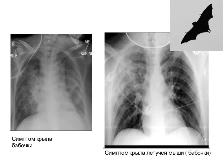 Симптом крыла бабочки Симптом крыла летучей мыши ( бабочки)