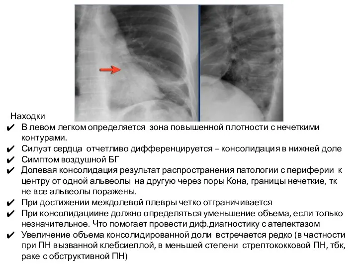 Находки В левом легком определяется зона повышенной плотности с нечеткими