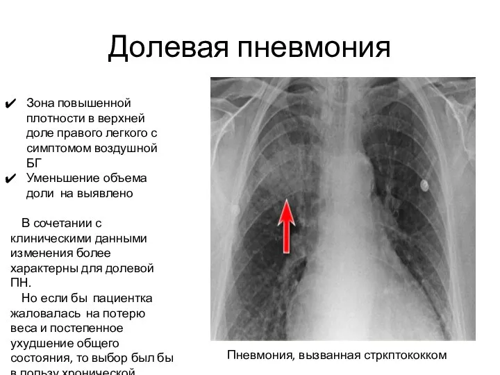 Долевая пневмония Зона повышенной плотности в верхней доле правого легкого