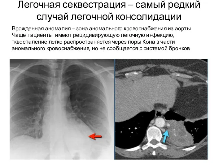 Легочная секвестрация – самый редкий случай легочной консолидации Врожденная аномалия