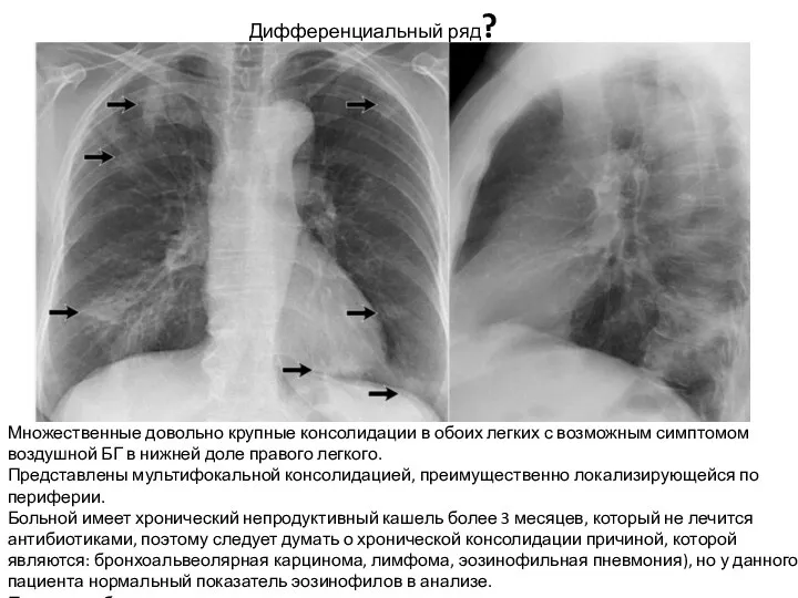 Множественные довольно крупные консолидации в обоих легких с возможным симптомом
