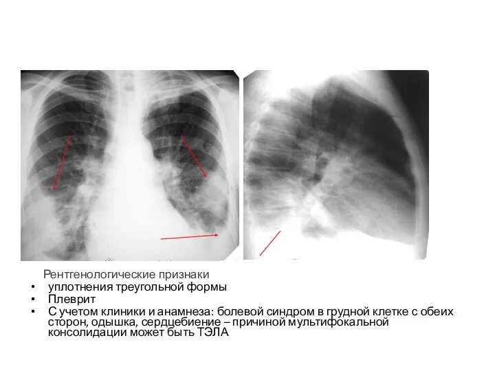 Рентгенологические признаки уплотнения треугольной формы Плеврит С учетом клиники и