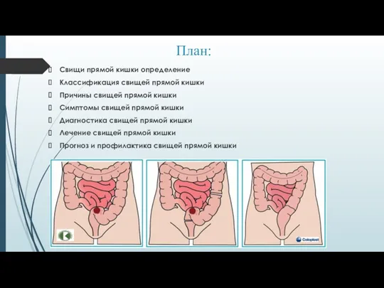 План: Свищи прямой кишки определение Классификация свищей прямой кишки Причины