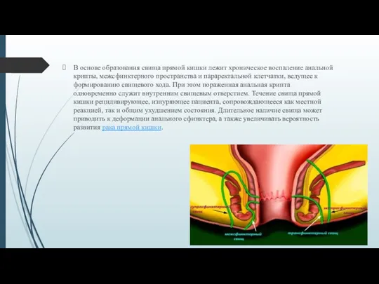 В основе образования свища прямой кишки лежит хроническое воспаление анальной