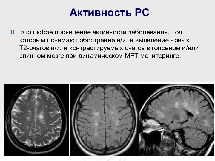 Активность РС это любое проявление активности заболевания, под которым понимают