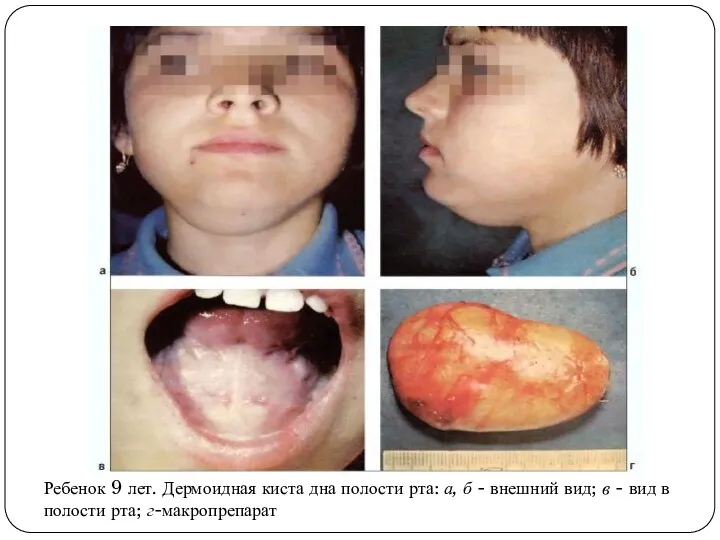 Ребенок 9 лет. Дермоидная киста дна полости рта: а, б - внешний вид;