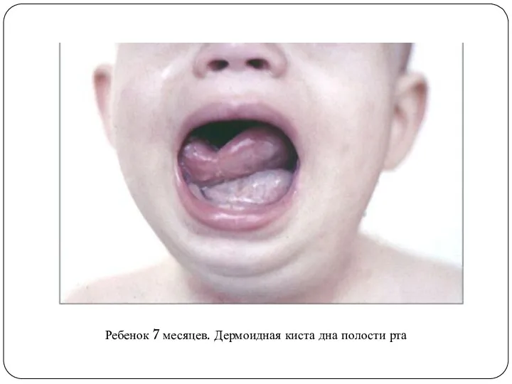 Ребенок 7 месяцев. Дермоидная киста дна полости рта